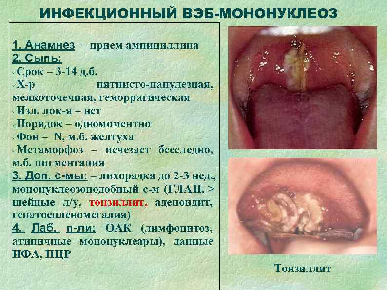  ИНФЕКЦИОННЫЙ ВЭБ-МОНОНУКЛЕОЗ 1. Анамнез – прием ампициллина 2. Сыпь:  Срок – 3