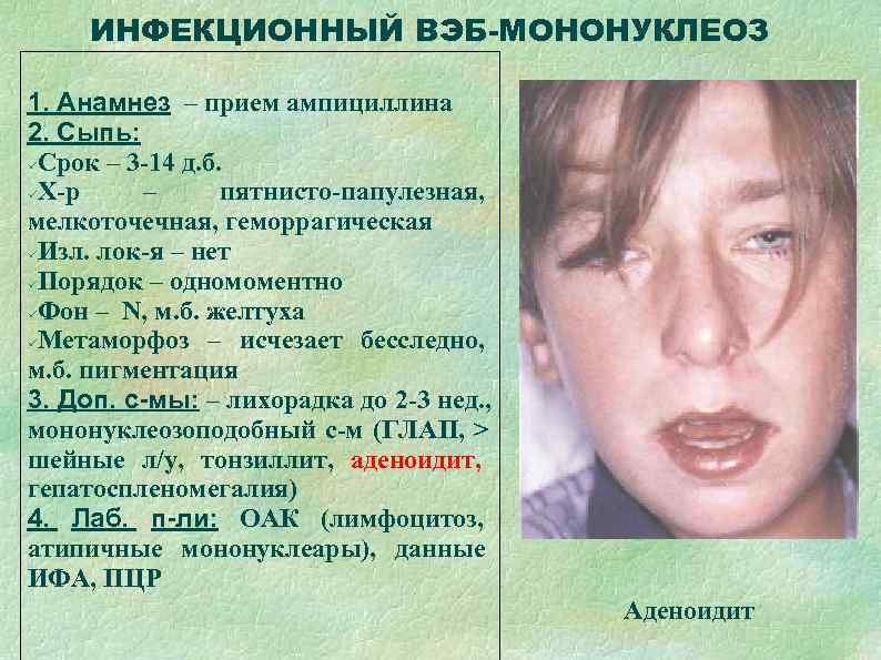  ИНФЕКЦИОННЫЙ ВЭБ-МОНОНУКЛЕОЗ 1. Анамнез – прием ампициллина 2. Сыпь:  Срок – 3