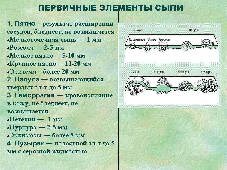    ПЕРВИЧНЫЕ ЭЛЕМЕНТЫ СЫПИ 1. Пятно – результат расширения сосудов, бледнеет, не