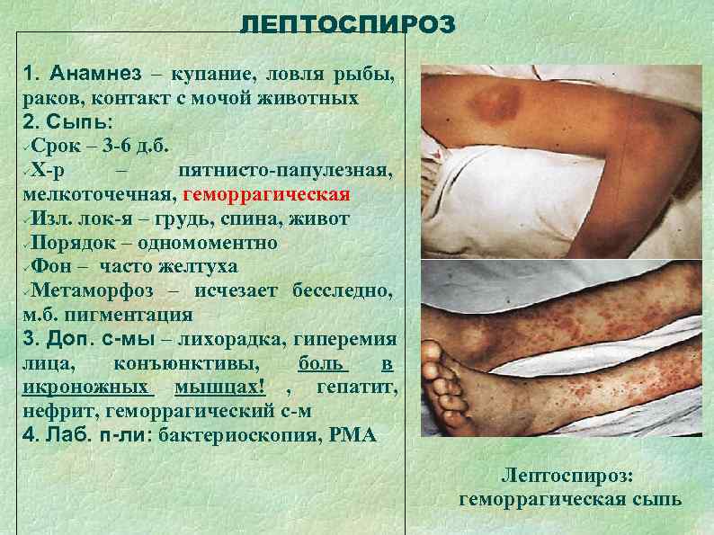      ЛЕПТОСПИРОЗ 1. Анамнез – купание, ловля рыбы, раков, контакт