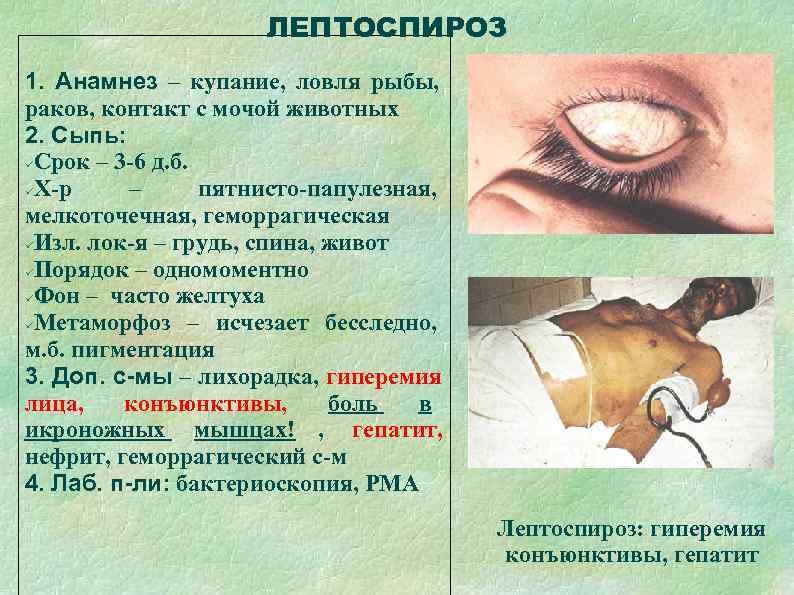      ЛЕПТОСПИРОЗ 1. Анамнез – купание, ловля рыбы, раков, контакт