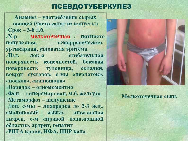     ПСЕВДОТУБЕРКУЛЕЗ Анамнез – употребление сырых  овощей (часто салат из