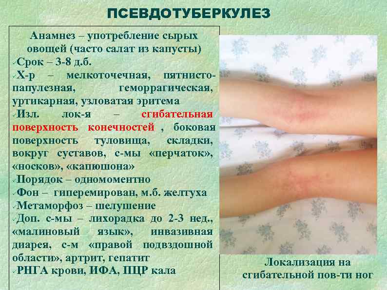    ПСЕВДОТУБЕРКУЛЕЗ Анамнез – употребление сырых  овощей (часто салат из капусты)