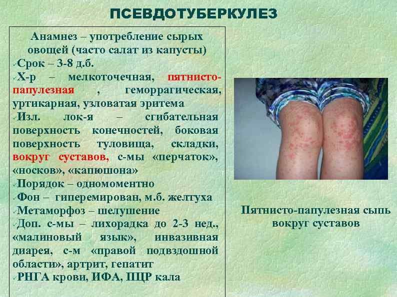    ПСЕВДОТУБЕРКУЛЕЗ Анамнез – употребление сырых  овощей (часто салат из капусты)