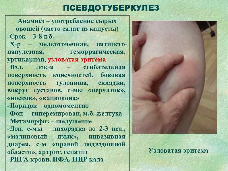    ПСЕВДОТУБЕРКУЛЕЗ Анамнез – употребление сырых  овощей (часто салат из капусты)