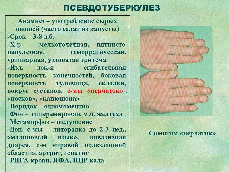    ПСЕВДОТУБЕРКУЛЕЗ Анамнез – употребление сырых  овощей (часто салат из капусты)