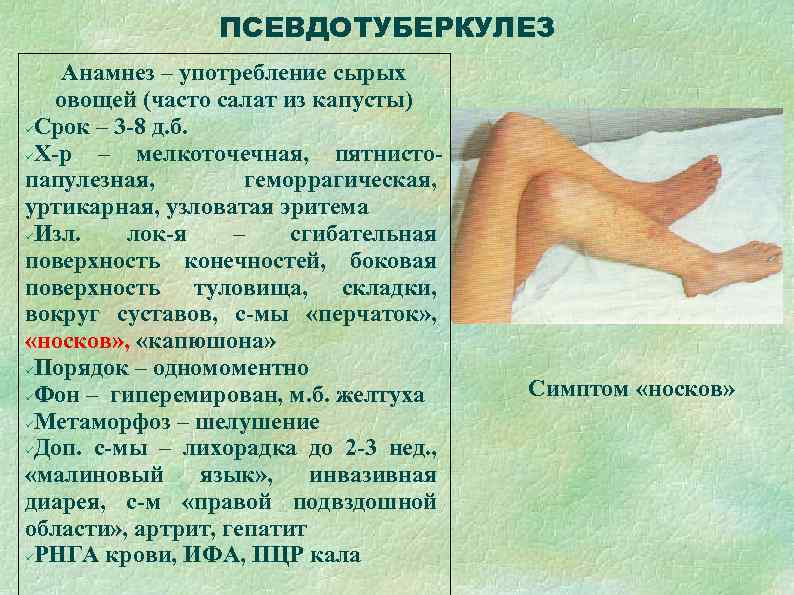    ПСЕВДОТУБЕРКУЛЕЗ Анамнез – употребление сырых  овощей (часто салат из капусты)
