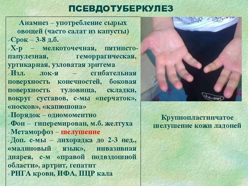    ПСЕВДОТУБЕРКУЛЕЗ Анамнез – употребление сырых  овощей (часто салат из капусты)