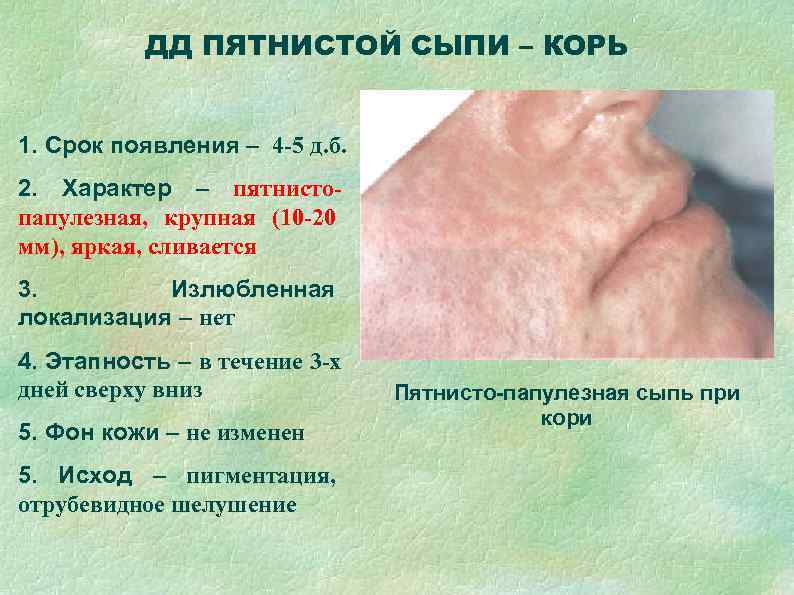   ДД ПЯТНИСТОЙ СЫПИ – КОРЬ  1. Срок появления – 4 -5