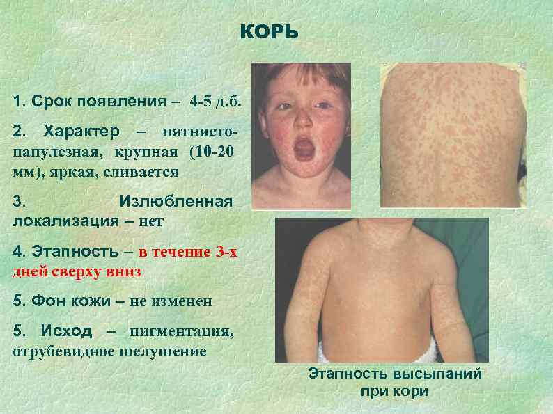       КОРЬ  1. Срок появления – 4 -5