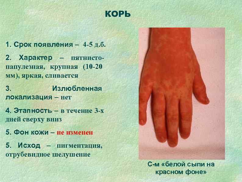       КОРЬ  1. Срок появления – 4 -5