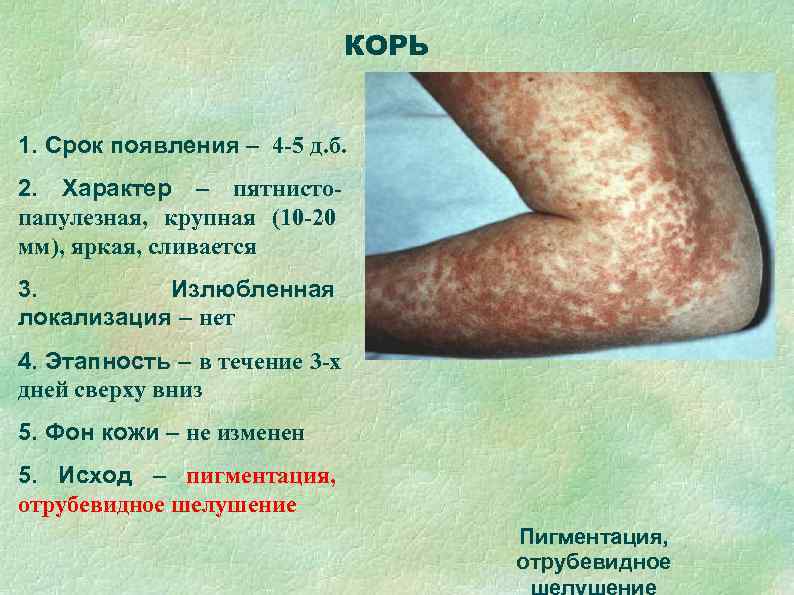       КОРЬ  1. Срок появления – 4 -5