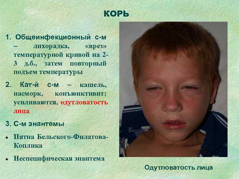      КОРЬ 1. Общеинфекционный с-м  –  лихорадка, «врез»