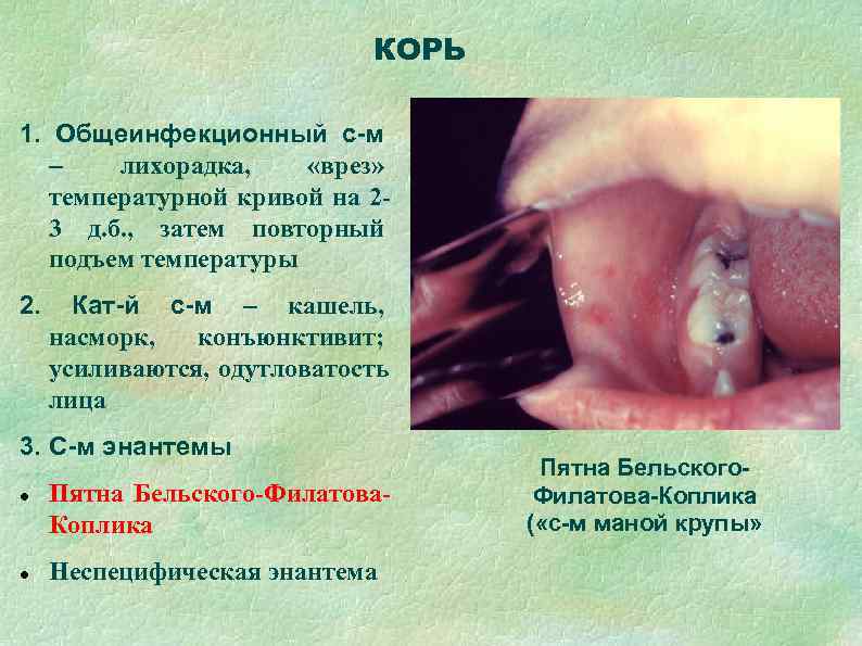      КОРЬ 1. Общеинфекционный с-м  –  лихорадка, «врез»