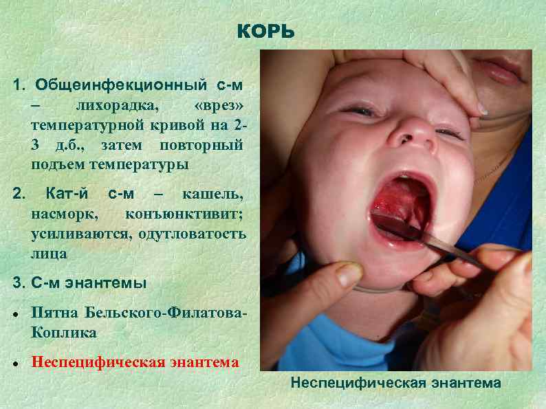      КОРЬ 1. Общеинфекционный с-м  –  лихорадка, «врез»