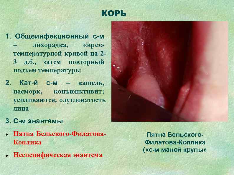      КОРЬ 1. Общеинфекционный с-м  –  лихорадка, «врез»