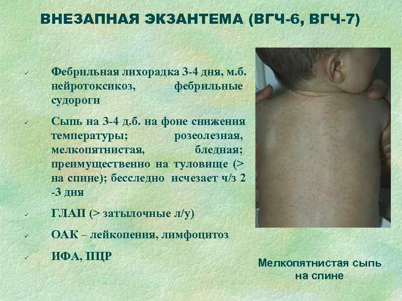   ВНЕЗАПНАЯ ЭКЗАНТЕМА (ВГЧ-6, ВГЧ-7)  Фебрильная лихорадка 3 -4 дня, м. б.
