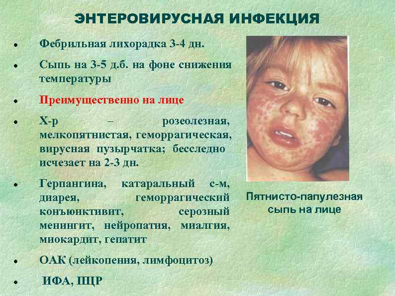    ЭНТЕРОВИРУСНАЯ ИНФЕКЦИЯ Фебрильная лихорадка 3 -4 дн. Сыпь на 3 -5
