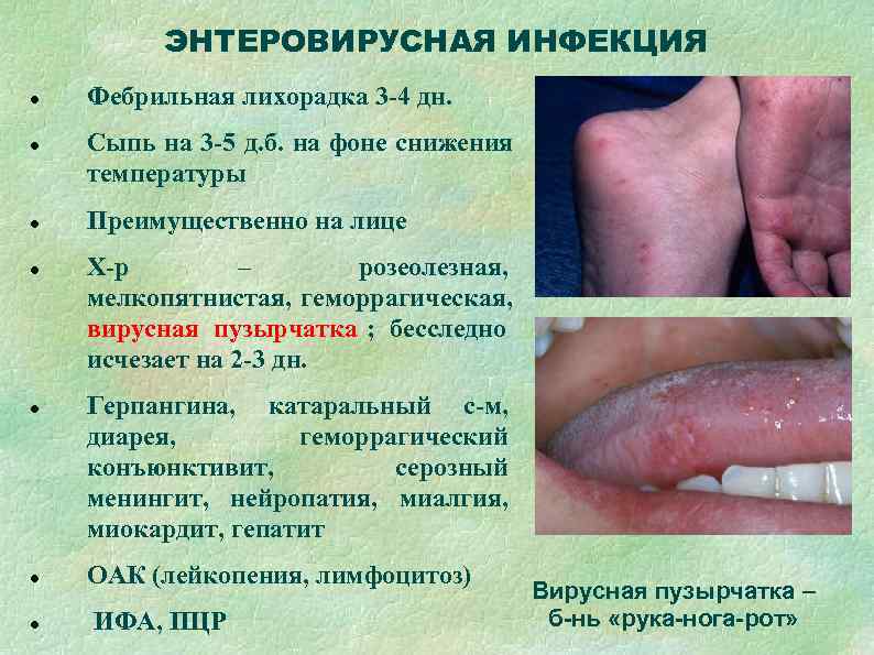    ЭНТЕРОВИРУСНАЯ ИНФЕКЦИЯ Фебрильная лихорадка 3 -4 дн. Сыпь на 3 -5