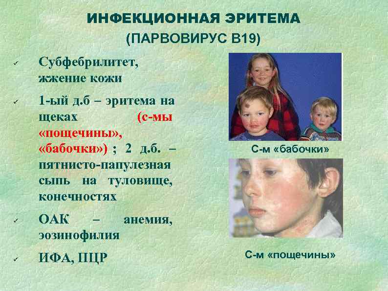   ИНФЕКЦИОННАЯ ЭРИТЕМА    (ПАРВОВИРУС В 19) Субфебрилитет, жжение кожи 1