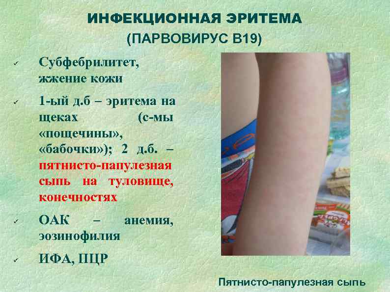   ИНФЕКЦИОННАЯ ЭРИТЕМА    (ПАРВОВИРУС В 19) Субфебрилитет, жжение кожи 1