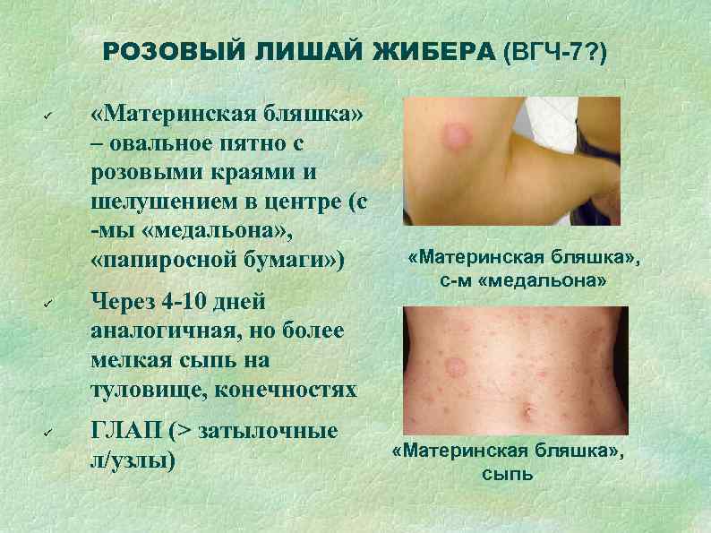   РОЗОВЫЙ ЛИШАЙ ЖИБЕРА (ВГЧ-7? )  «Материнская бляшка» – овальное пятно с