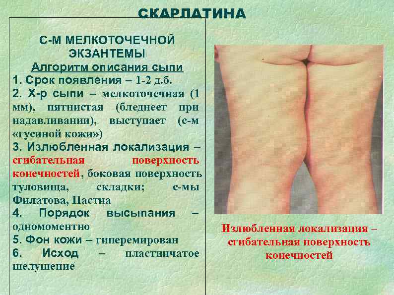      СКАРЛАТИНА С-М МЕЛКОТОЧЕЧНОЙ  ЭКЗАНТЕМЫ Алгоритм описания сыпи 1.