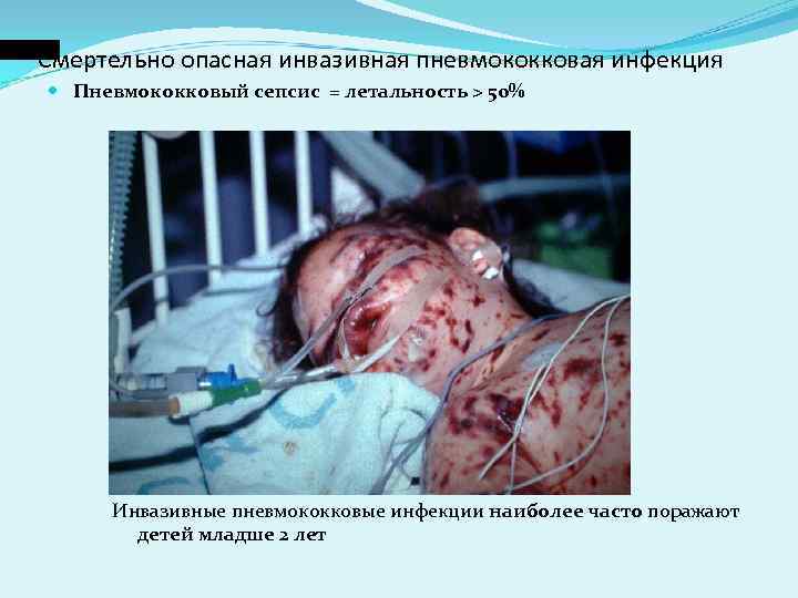 Смертельно опасная инвазивная пневмококковая инфекция Пневмококковый сепсис = летальность > 50% Смертельно опасная инвазивная пневмококковая инфекция Пневмококковый сепсис = летальность > 50%