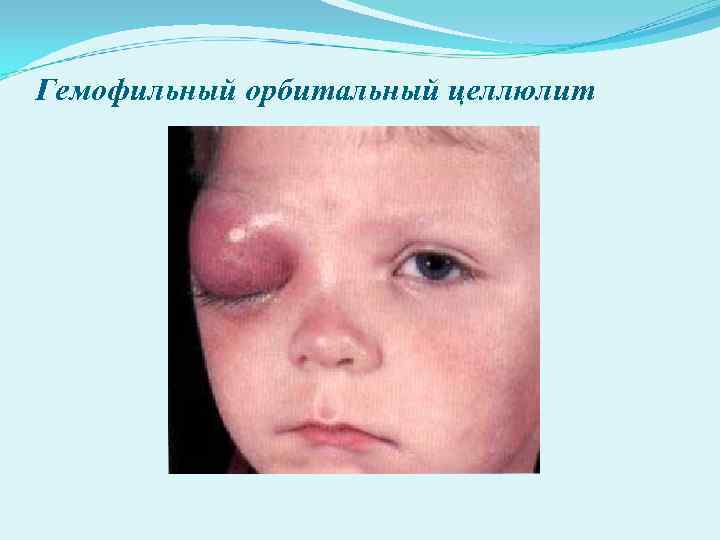 Гемофильный орбитальный целлюлит Гемофильный орбитальный целлюлит