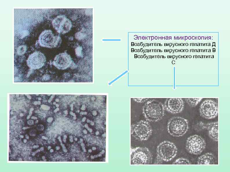 Электронная микроскопия: Возбудитель вирусного гепатита Д Возбудитель вирусного гепатита В Возбудитель вирусного гепатита 