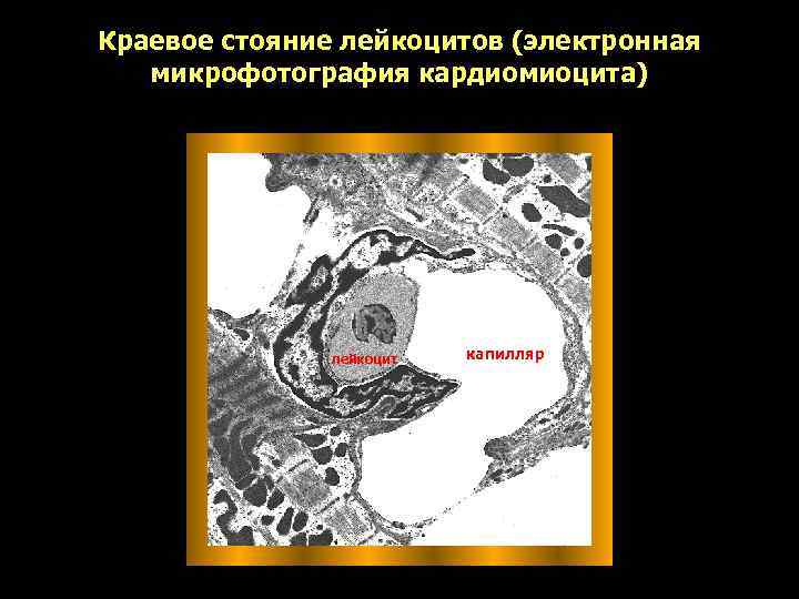 Краевое стояние лейкоцитов (электронная  микрофотография кардиомиоцита)    лейкоцит  капилляр 