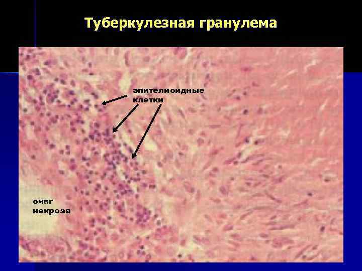    Туберкулезная гранулема    эпителиоидные    клетки очаг