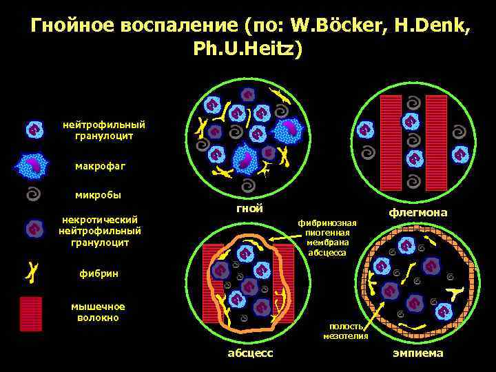 Гнойное воспаление (по: W. Böcker, H. Denk,    Ph. U. Heitz) нейтрофильный