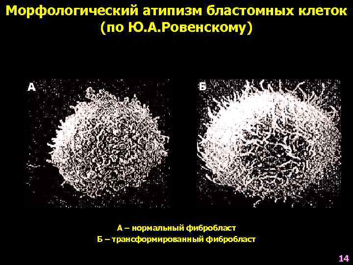 Морфологический атипизм бластомных клеток  (по Ю. А. Ровенскому)    А –
