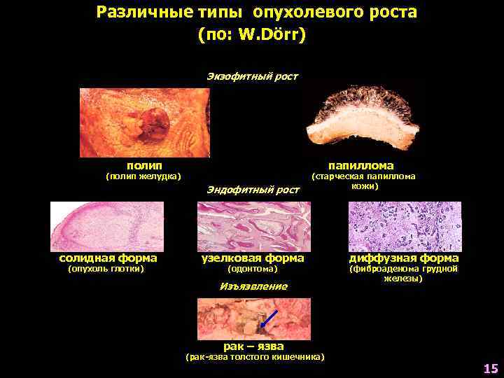  Различные типы опухолевого роста  (по: W. Böcker, H. Denk, Ph. U. Heitz)