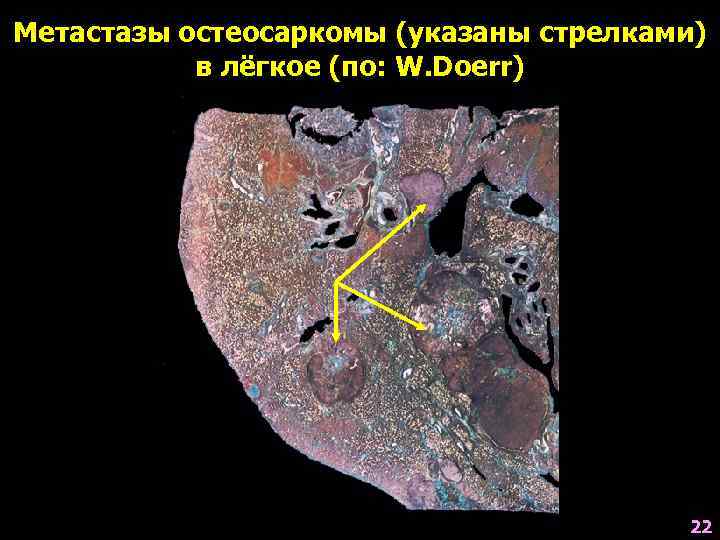 Метастазы остеосаркомы (указаны стрелками)  в лёгкое (по: W. Doerr)    