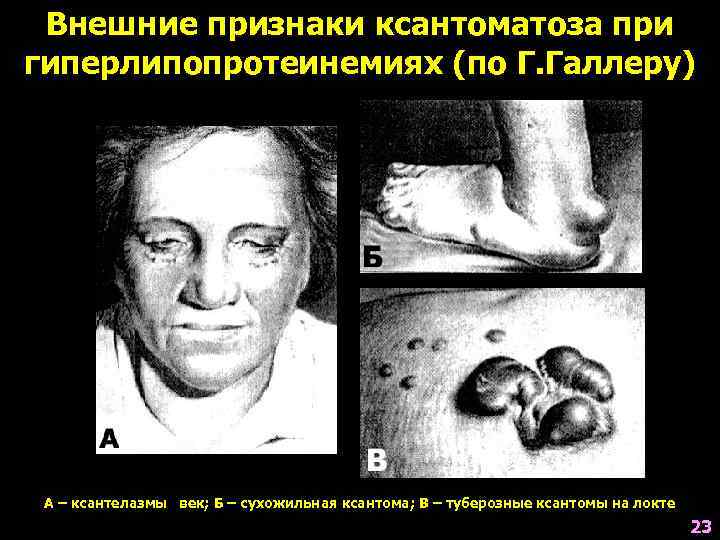  Внешние признаки ксантоматоза при гиперлипопротеинемиях (по Г. Галлеру) А – ксантелазмы век; Б
