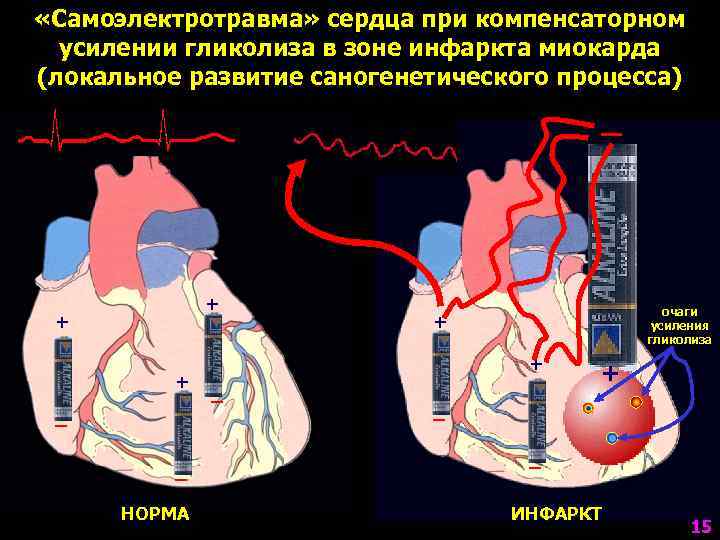  «Самоэлектротравма» сердца при компенсаторном  усилении гликолиза в зоне инфаркта миокарда (локальное развитие