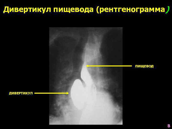 Дивертикул пищевода (рентгенограмма)       ПИЩЕВОД ДИВЕРТИКУЛ   