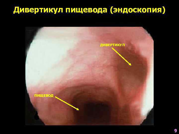Дивертикул пищевода (эндоскопия)     ДИВЕРТИКУЛ   ПИЩЕВОД   