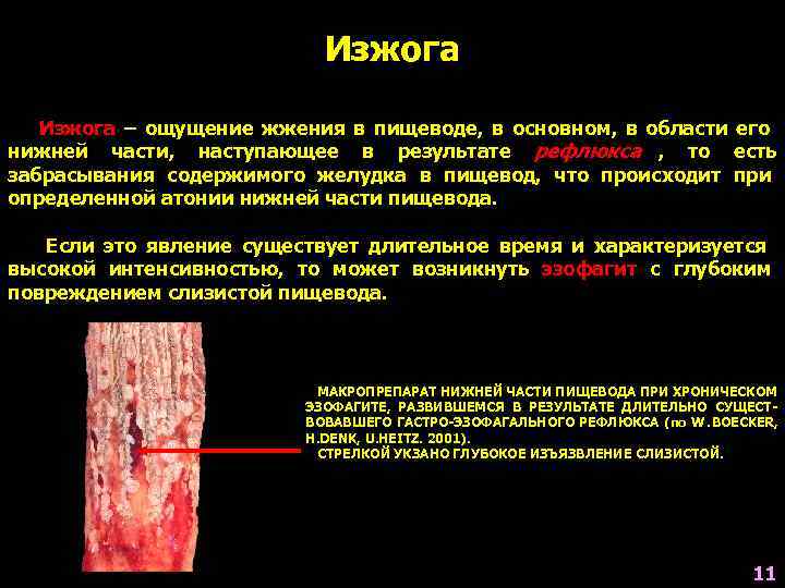       Изжога – ощущение жжения в пищеводе, в основном,