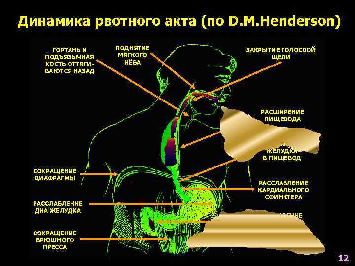 Динамика рвотного акта (по D. M. Henderson) ГОРТАНЬ И ПОДНЯТИЕ  ЗАКРЫТИЕ ГОЛОСВОЙ 