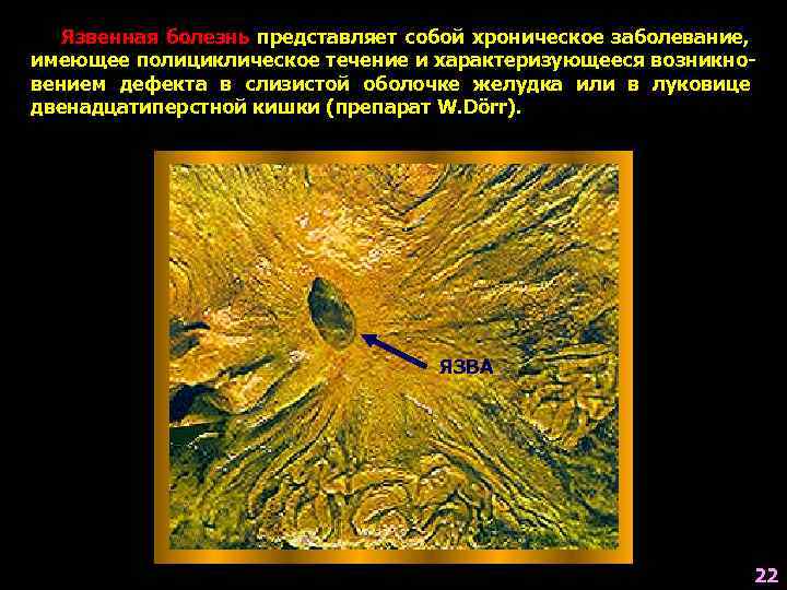   Язвенная болезнь представляет собой хроническое заболевание, имеющее полициклическое течение и характеризующееся возникно-