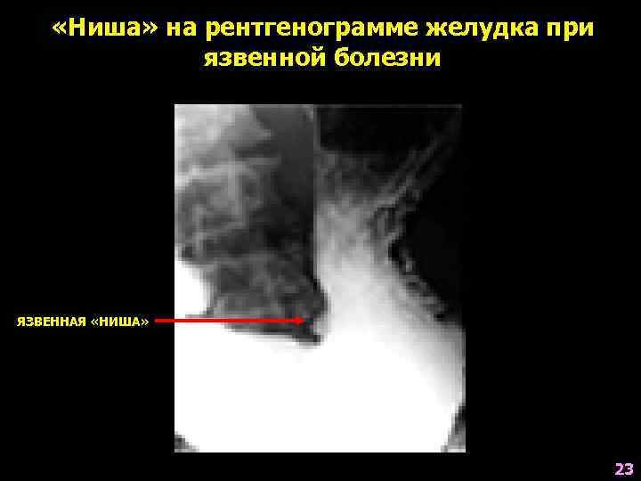   «Ниша» на рентгенограмме желудка при   язвенной болезни ЯЗВЕННАЯ «НИША» 