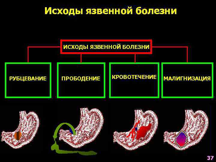    Исходы язвенной болезни    ИСХОДЫ ЯЗВЕННОЙ БОЛЕЗНИ РУБЦЕВАНИЕ 