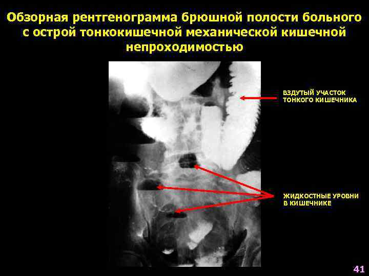 Обзорная рентгенограмма брюшной полости больного  с острой тонкокишечной механической кишечной   непроходимостью