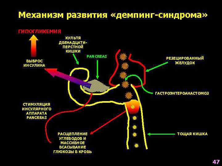 Механизм развития «демпинг-синдрома» ГИПОГЛИКЕМИЯ    КУЛЬТЯ   ДВЕНАДЦАТИ-   