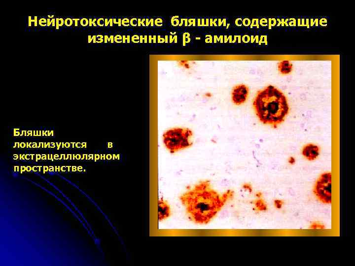 Нейротоксические бляшки, содержащие   измененный β - амилоид Бляшки локализуются  в