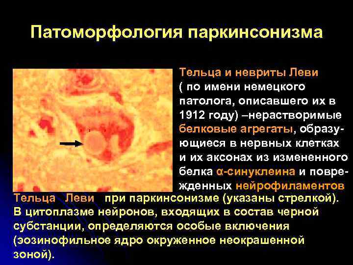  Патоморфология паркинсонизма     Тельца и невриты Леви   