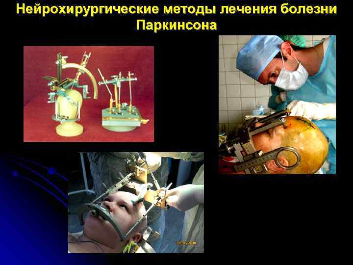 Нейрохирургические методы лечения болезни   Паркинсона 